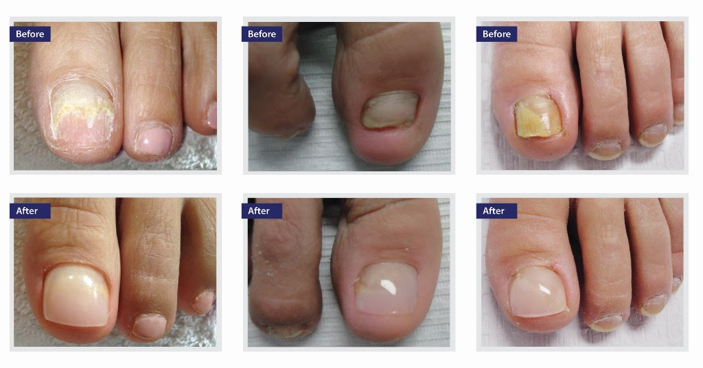 Forest Hills Split Nail Treatment Toenail Restoration In Forest Hills